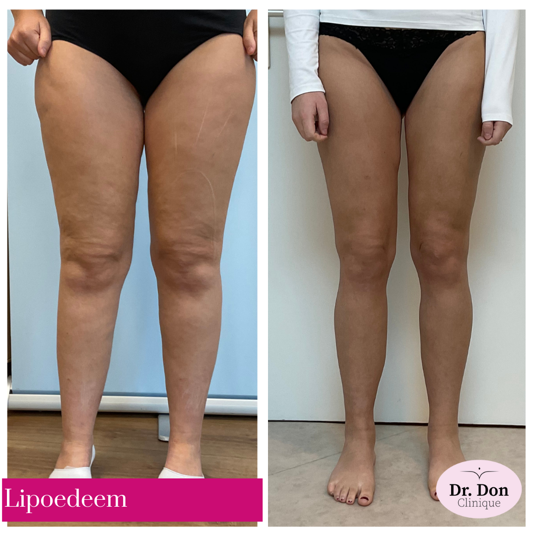 lipoedeem benen  clinique dr. don